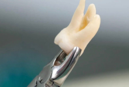 Endodoncia